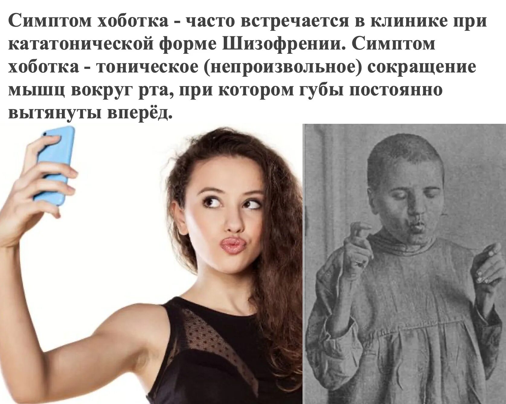 Почему сводит губы. Кататонический ступор губы. болезнь вытянутые губы.