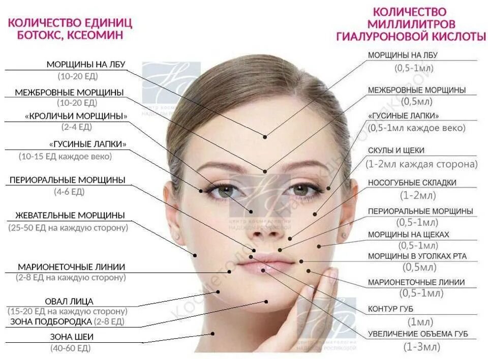 Единица ботокса это сколько мл. Ботокс в лоб схема введения. точки введения ботулотоксина на лице. схема уколов ботокса на лице. точки введения ботокса в лоб.