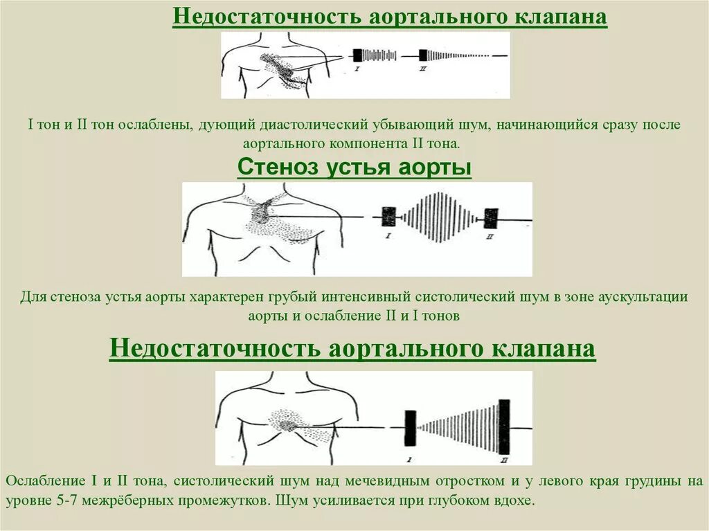 Шум после ковида. Недостаточность аортального клапана аускультация. Аортальная недостаточность ФКГ. Аортальная недостаточность 2 степени аускультация. Аускультация при аортальной недостаточности.