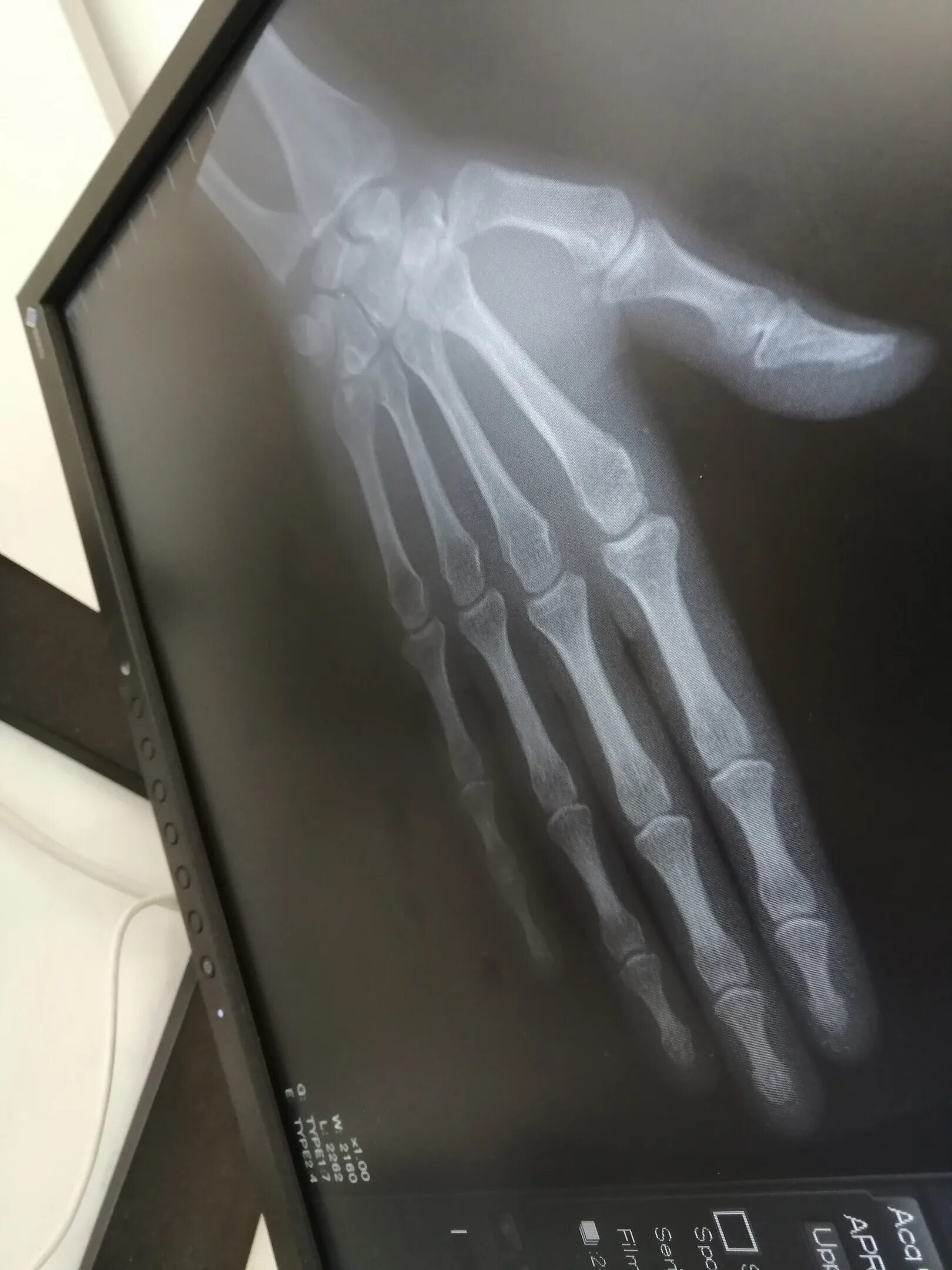 Снимок сломанной ноги рентген.