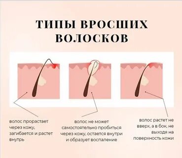 Какие виды эпиляции бывают