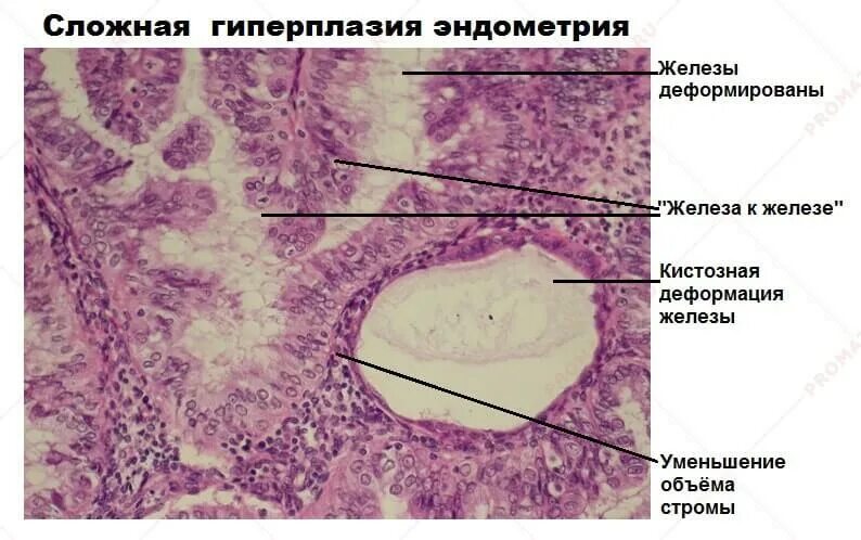 Железисто-кистозная гиперплазия эндометрия микропрепарат. Железистый эпителий гистология матки. Сложная гиперплазия эндометрия гистология. Простая гиперплазия эндометрия гистология. Диффузно узловая гиперплазия железы