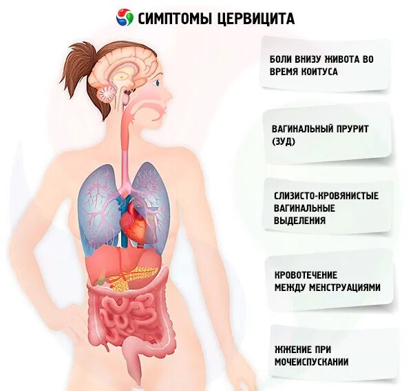 Цервицит клинические проявления.