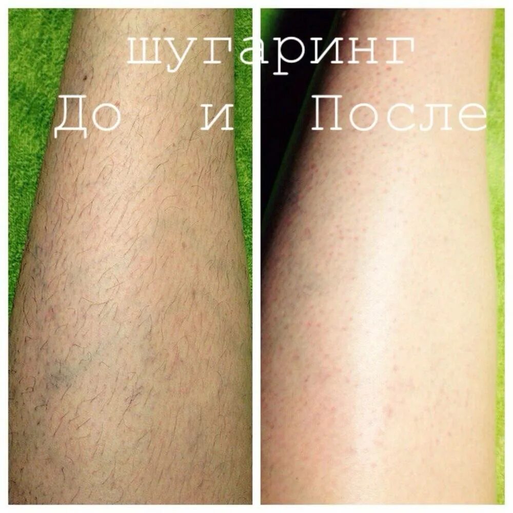 Шугаринг ног. Депиляция ног до и после. Волосы на ногах для шугаринга. Через сколько после бритья