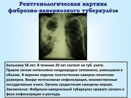 Осложнением фиброзно кавернозного туберкулеза является