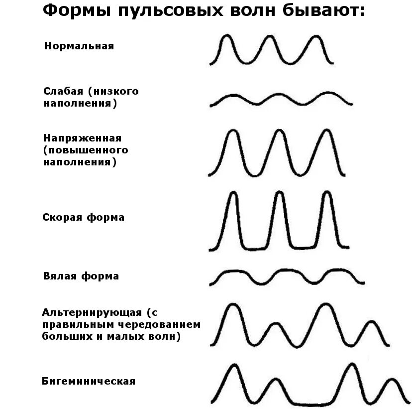 Норма форма сердца. Форма пульсовой волны в норме. Патологические формы пульса. Пульс норма диаграмма. Виды пульсовой волны.