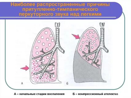 Звук легких