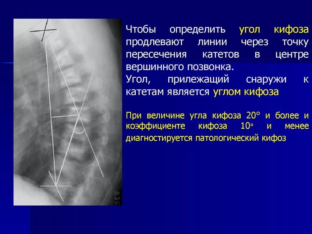 Грудной кифоз степени рентген. Угол Кобба кифоз рентгена. Кифоз рентген по коббу. Угол кифоза по коббу степени.