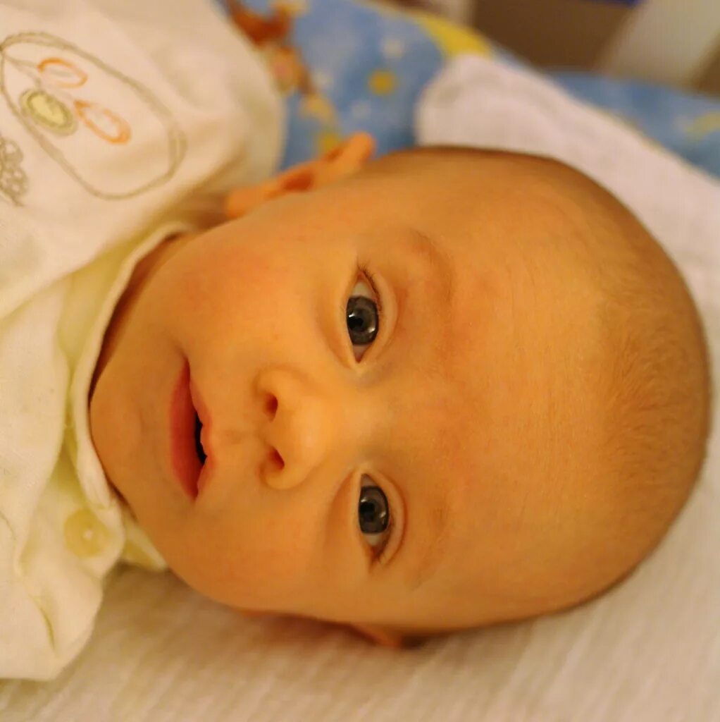 Желтый малыш. Желтушка у новорожденного. Физиологическая желтушка у новорожденных. Патологическая желтушка у новорожденных. Транзиторная желтуха новорожденных.