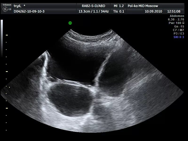 Узи мочевого пузыря нормальные показатели. Мегауретер на узи. Узи мочевого пузыря показатели в норме. Узи мочевого пузыря показатели в норме. Ультразвуковая анатомия мочевого пузыря.