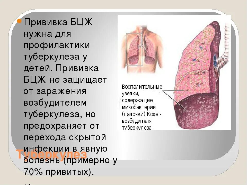 Туберкулезом вакцину бцж. Прививка на туберкулёз детям. Прививка от туберкулеза куда. Название прививки от туберкулеза детям.