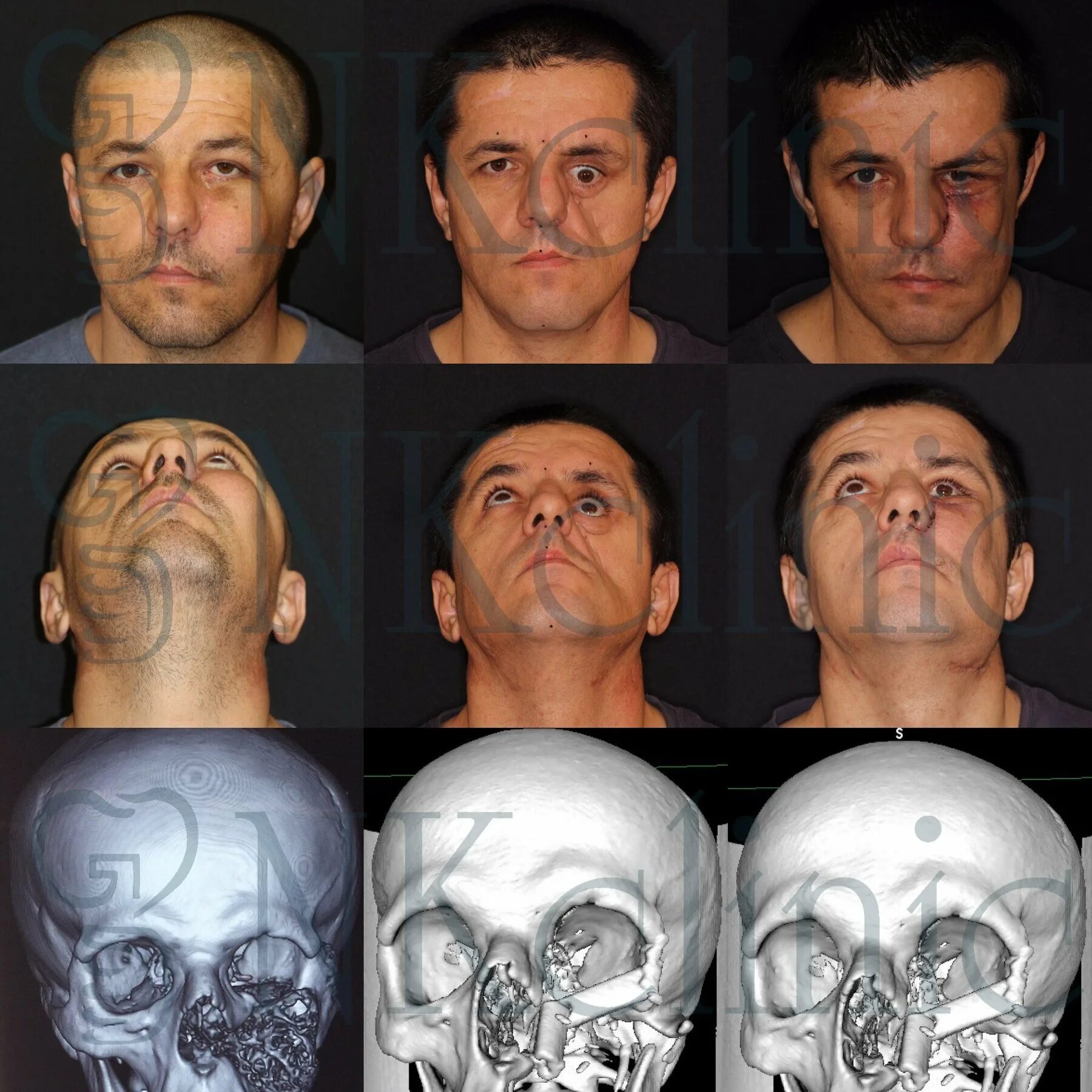 черепно лицевая хирургия. черепно лицевая хирургия. челюстно-лицевой хирург до после. перелом челюстно-лицевой кости. перелом скуловой кости верхней челюсти.