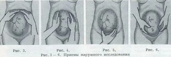 Приемы леопольда алгоритм. 4 Прием Леопольда Левицкого. Приемы наружного акушерского исследования Леопольда Левицкого. Пальпация Леопольда Левицкого. Методы Леопольда Левицкого 4 приема в акушерстве.