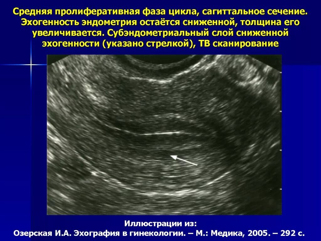 УЗИ нормального эндометрия. Эндометрий фазы пролиферации на УЗИ. Эндометрий 2 фаза цикла УЗИ. Эндометрий во второй фазе цикла УЗИ.