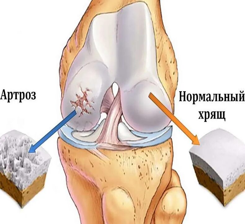 Клиники лечения коленного сустава. Артроз коленного сустава. Артроз коленного счуст АВ. Ортроз коленного сустав.