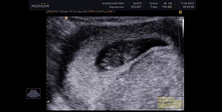 Эмбрион 8 недель УЗИ. Фото эмбриона на 8 неделе беременности на УЗИ. Фото УЗИ на 8 неделе беременности акушерской. Эмбрион на 8 неделе беременности УЗИ. Тянет живот на 8 неделе