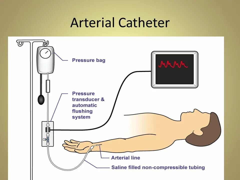 Прямой метод измерения давления. Прямой способ измерения ад. Инвазивное измерение артериального давления методика. Неинвазивные методы измерения ад. Методы определения кровяного давления.