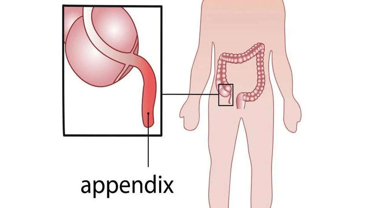 Атавизмы человека аппендикс. Расположение аппендикса у детей. Воспаленный аппендицит.
