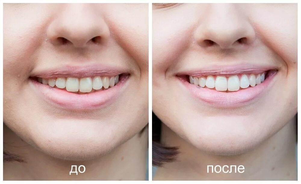 Почему зубы отличаются между собой. Отбеливание зубов до и после. Зубы до и после отбеливания. Отбеливание зубов до Посл.