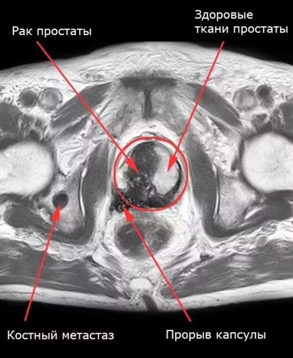 Кт малого таза с контрастом у мужчин. Опухоли предстательной железы мрт. Кт малого таза предстательная железа. Гипертрофия предстательной железы кт. Магнитно-резонансная томографии (мрт) предстательной железы.