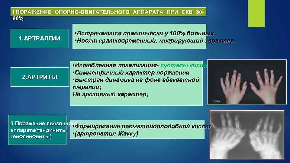 Поражение суставов при системной красной волчанке. Рентген суставов при системной красной волчанке. Системная красная волчанка артрит. Поражение суставов при СКВ. Красная волчанка ревматоидный артрит