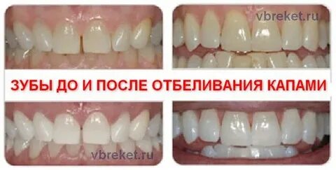 Отбеливание капой отзывы