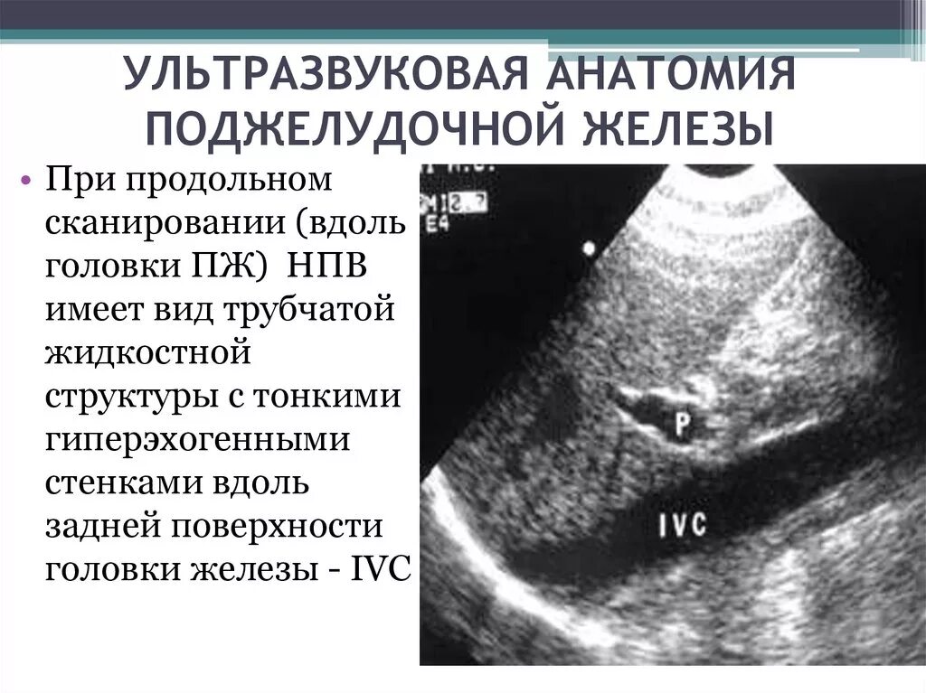 Поджелудочная диффузно повышенной эхогенности. Гиперэхогенное образование поджелудочной железы УЗИ. Кальцинаты поджелудочной железы УЗИ. Фиброз поджелудочной железы на УЗИ. Кальцификаты поджелудочной железы.