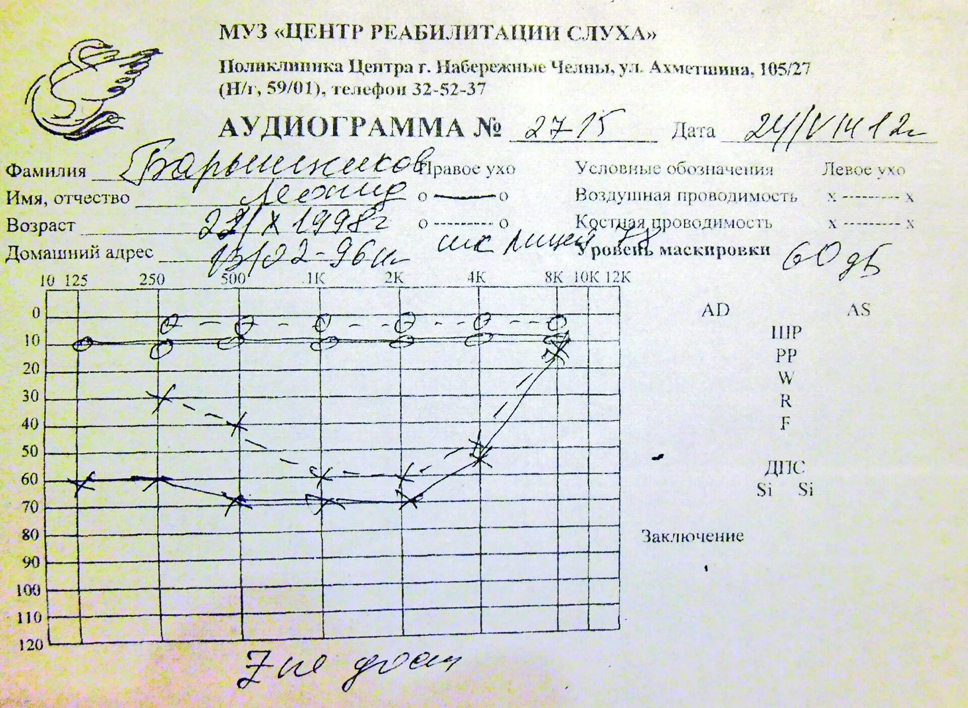 Тугоухость 2 степени. Сенсоневральная тугоухость. Аудиограмма норма заключение. Тугоухость заключение. Тугоухость клиника.