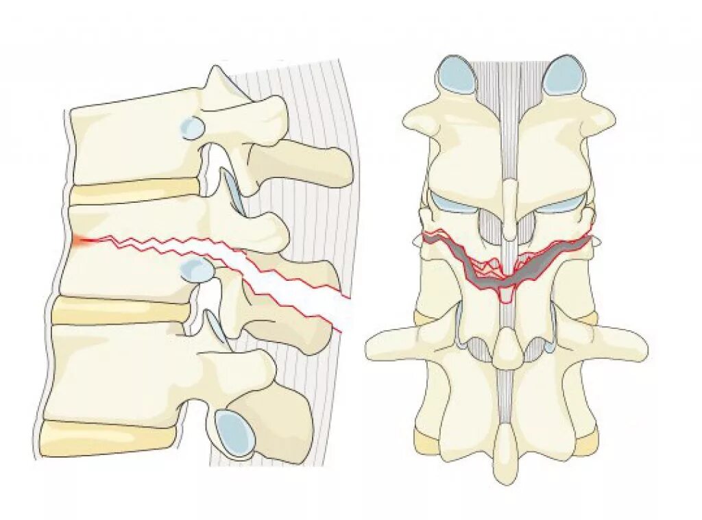 Дистракционный перелом позвоночника. Перелом верхней замыкательной пластинки кт. Ротационный перелом позвоночника.