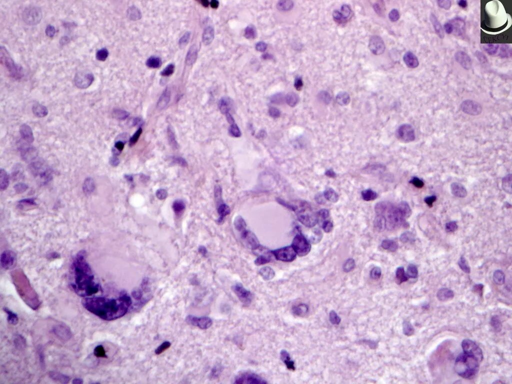 глиобластома патологическая анатомия. псаммоматозная менингиома. злокачественная менингиома гистология. олигодендроглиома гистология. астроцитома головного мозга гистология.