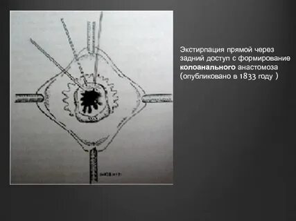 Экстирпация прямой