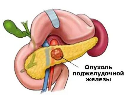 Опухоль на поджелудочной железе операция