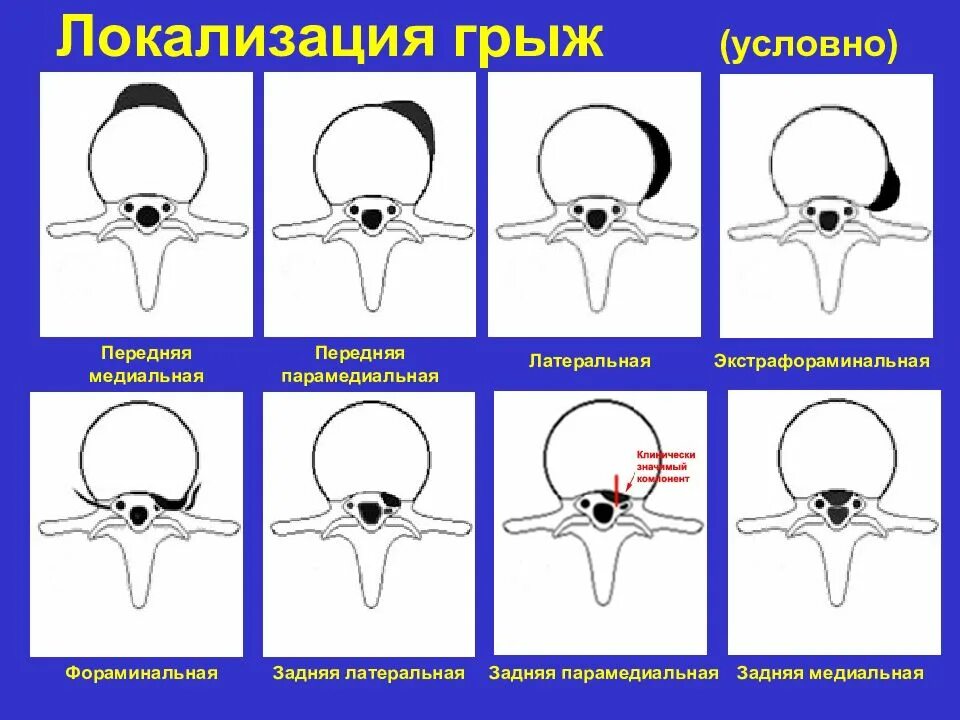 Медианно парамедианная билатеральная. Грыжи дисков классификация кт. Грыжи межпозвоночных дисков классификация. Классификация межпозвонковых грыж. Классификация грыж позвоночника по локализации.