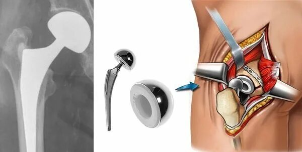 Операция по замене тазобедренного как происходит. Эндопротезирование ТБС. Эндопротезирование ТБС операция. Операция эндопротез тазобедренный. Операция эндопротезирование шейки бедра.