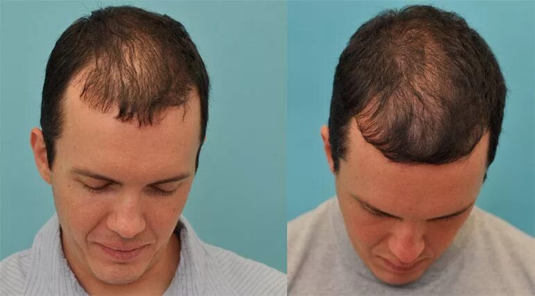 Для облысения волос для мужчин. Причёски при залысинах у мужчин. Плазмотерапия облысение. Плазмотерапия для волос мужчины.
