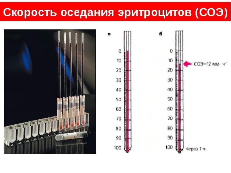 Что такое соэ. Метод панченкова соэ методика. измерение соэ по методу панченкова. методы соэ метод вестергрена. норма соэ по методу вестергрена и панченкова.