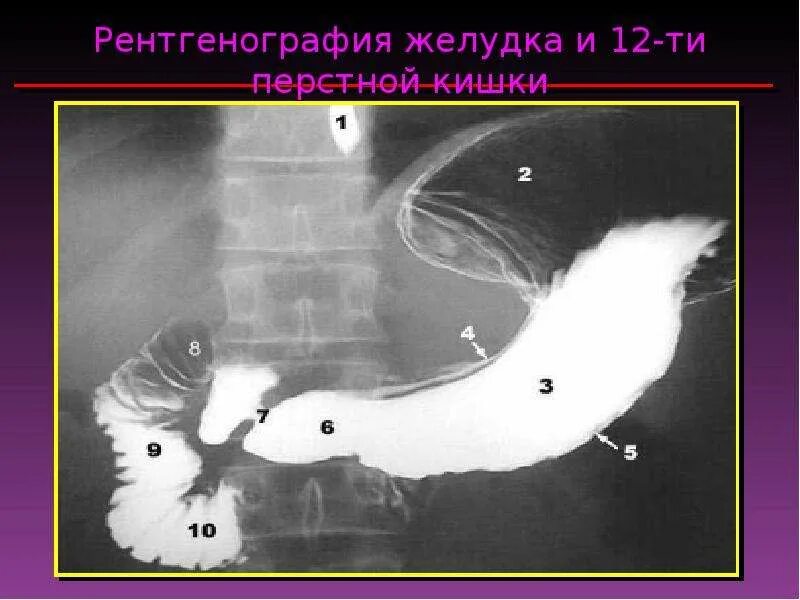 Рубцовая деформация луковицы двенадцатиперстной. Язва луковицы 12 перстной кишки рентген. пилорический отдел желудка рентген. рубцовая деформация луковицы дпк рентген. стеноз двенадцатиперстной кишки рентген.