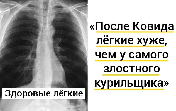 Рак легких Barzilai Medical Center