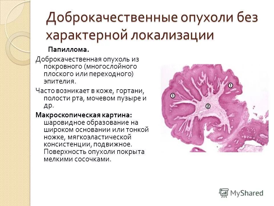 Злокачественный характер. Доброкачественная опухоль патанатомия. Переходно клеточная папиллома гистология. Доброкачественная опухоль гистология. Доброкачественные и злокачественные новообразования.