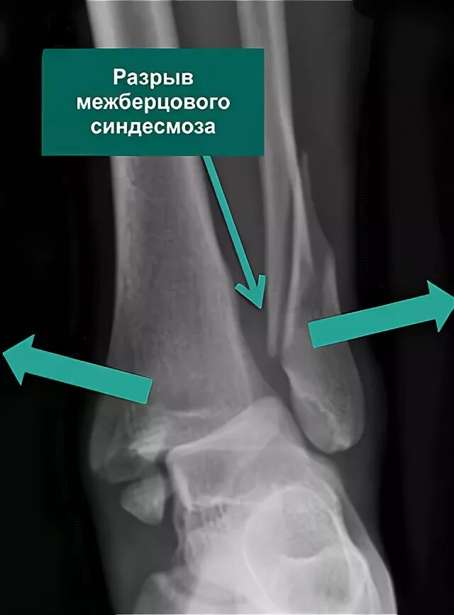 Дистальный разрыв. Синдесмоз голеностопного сустава. Межберцовый синдесмоз рентген. Разрыв дистального синдесмоза. Разрыв межберцового синдесмоза рентген.