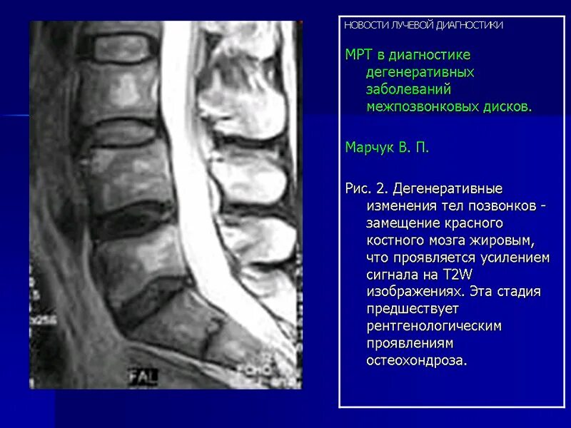 Реконверсия костного мозга мрт позвоночника. Инфаркт большеберцовой кости мрт. Отёк костного мозга коленного сустава на мрт. Мр сигнал от костного мозга. Инфаркт большеберцовой кости мрт.