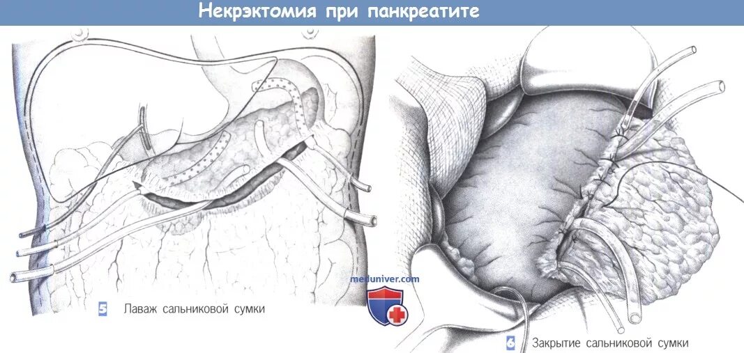 Сальниковая сумка поджелудочной железы при панкреатите. Некрэктомия поджелудочной железы. Дренирование панкреатита. Дренирование поджелудочной железы при панкреонекрозе. Поджелудочная железа панкреатит операция