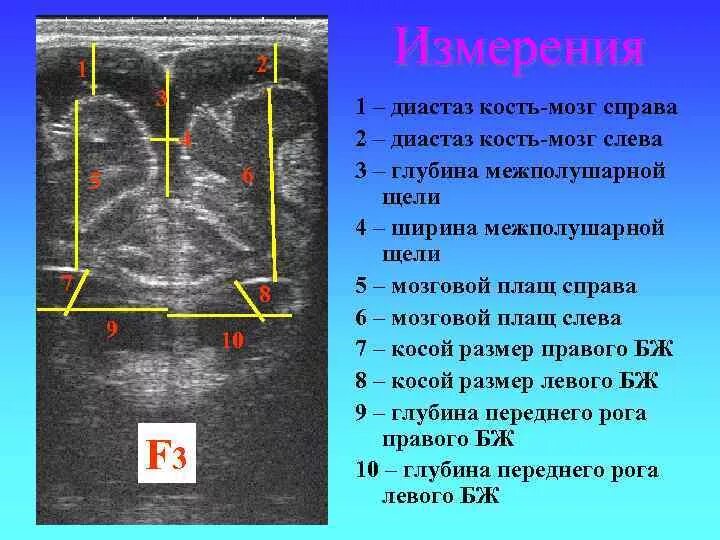 Измерение боковых желудочков на УЗИ. Нейросонография новорожденных нормы. Нейросонография методика измерения. Нейросонография Сагиттальный срез.