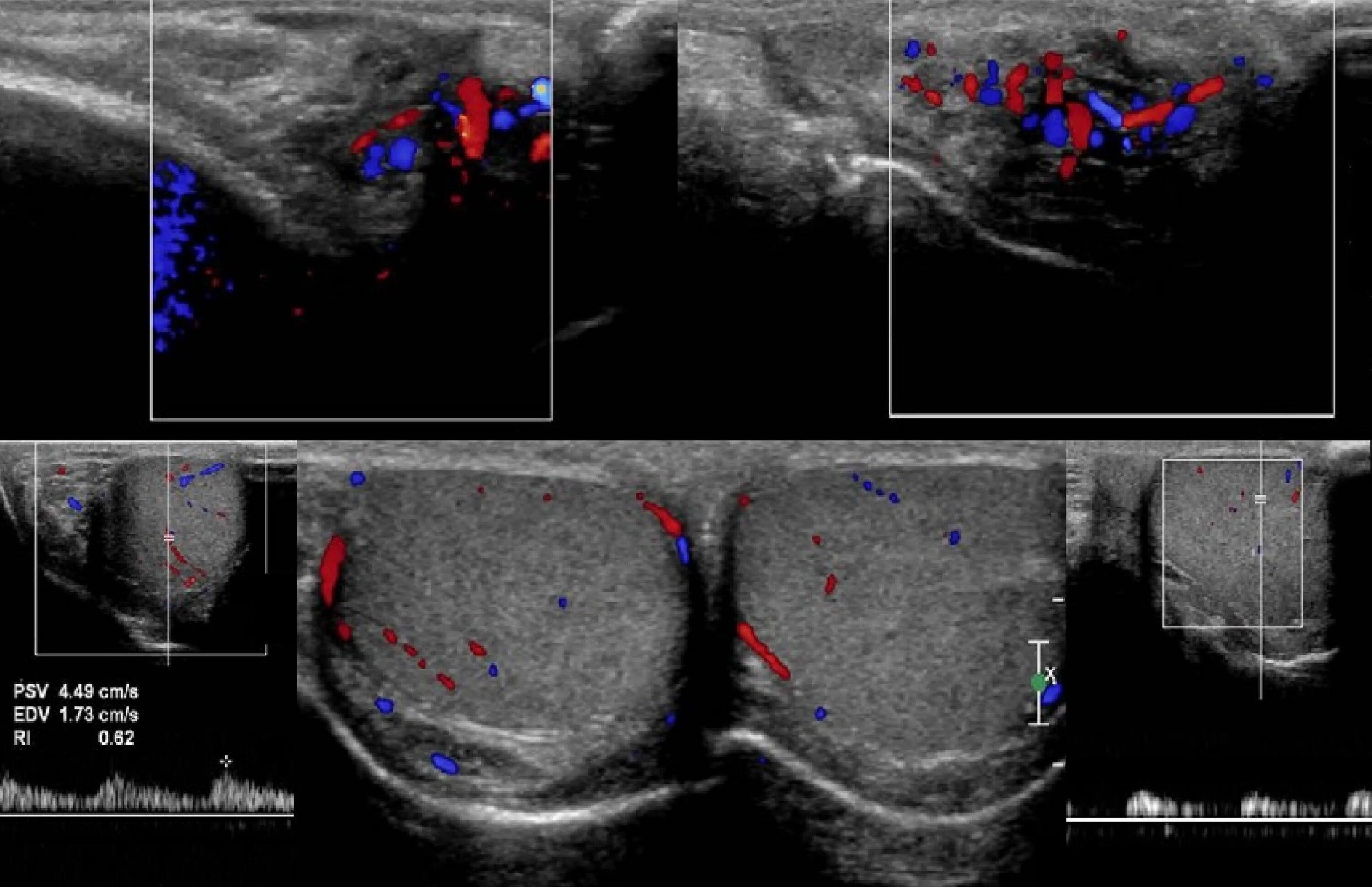 УЗИ мошонки варикоцеле 3 степени. Варикоз вен семенного канатика. Варикоцеле расширение вен. УЗИ вен семенного канатика. Расширение вены семенного канатика