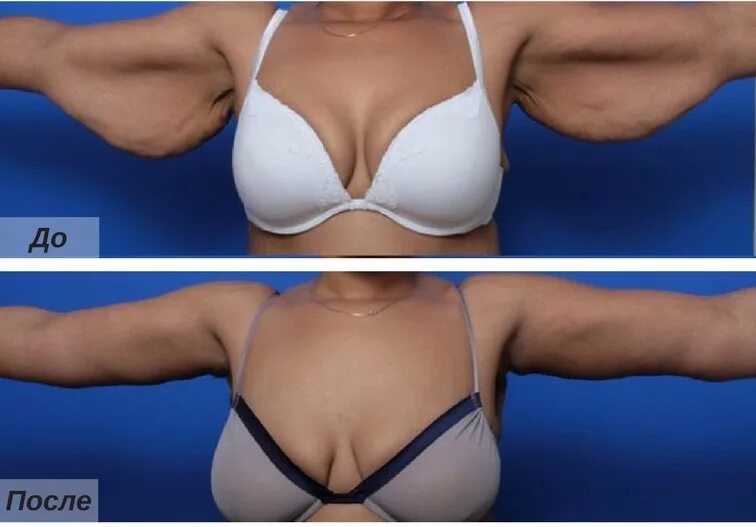 Нейропатия блокового нерва. Уменьшение рук. Уменьшение рук. Брахиопластика (пластика рук). Подтяжка рук брахиопластика.