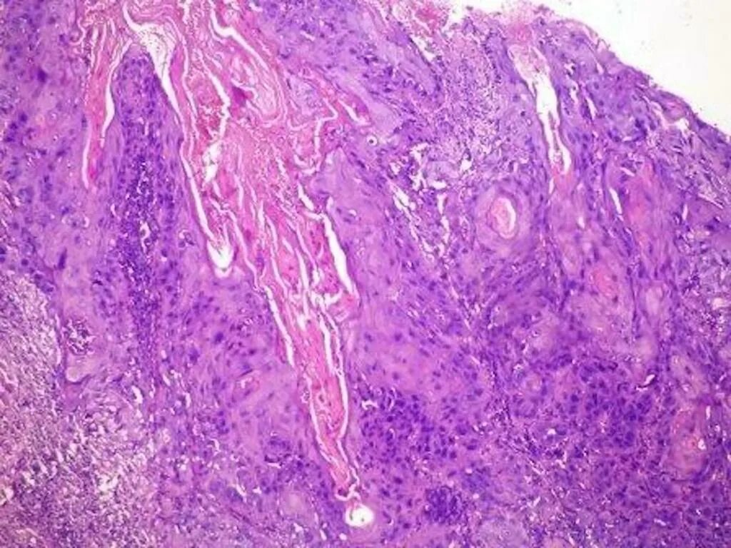 Плоскоклеточными опухолями. Squamous Cell carcinoma гистология. Трихоэпителиома гистология. Плоскоклеточный неороговевающий. Плоскоклеточная карцинома кожи.