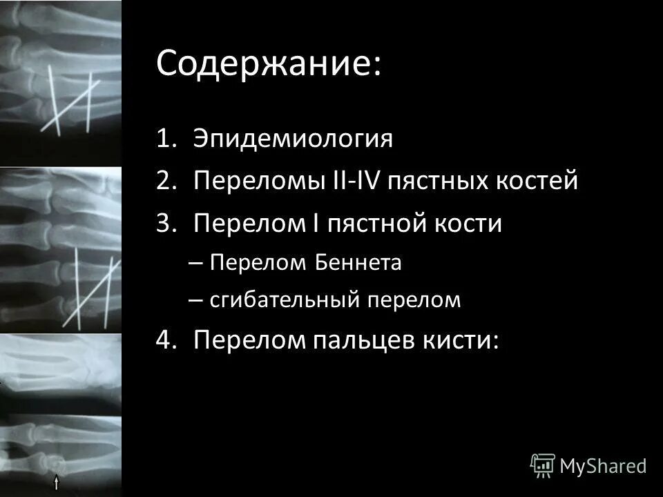 перелом головки 5 пястной кости правой кисти. код мкб перелом пястной кости кисти. краевой перелом основания пястной кости. код мкб перелом пястной кости кисти. перелом беннета 1 пястной кости.
