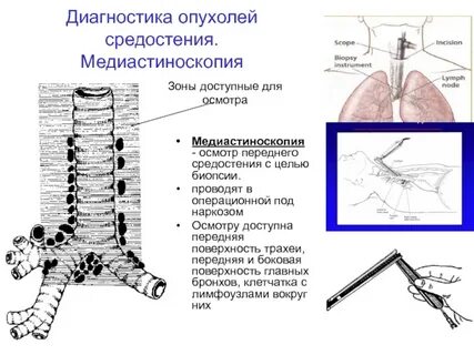 Узел средостения