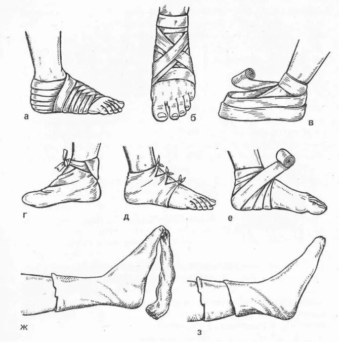 Какая повязка при повреждении голеностопного сустава. Бинтование при растяжении голеностопа. Бинтование ноги при растяжении голеностопа. Эластичное бинтование голеностопного сустава при растяжении. Фиксация голеностопа при растяжении связок эластичным бинтом.