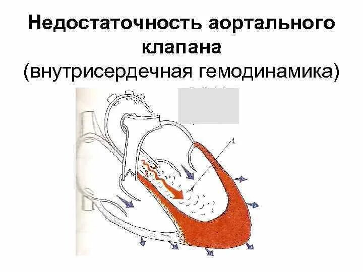 Нарушение внутрисердечной гемодинамики